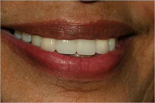 Dental Implants After