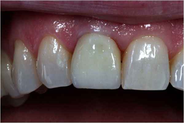 Dental Implants After