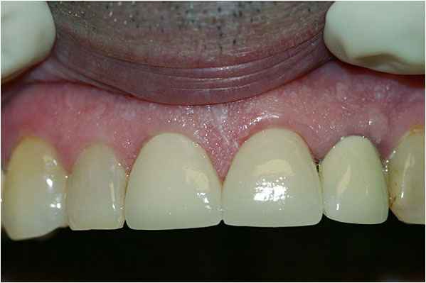 Dental Crowns After